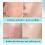 ⁦مجموعة موِيكا لتنقية البشرة وتقليل الحبوب⁩ - الصورة ⁦3⁩